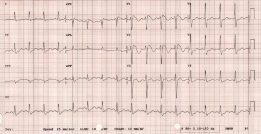 Brugada-type-1 - Medical Exam Prep