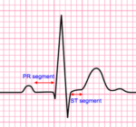 The Basics of ECG Interpretation (Part 3 – Waves, Segments & Intervals)