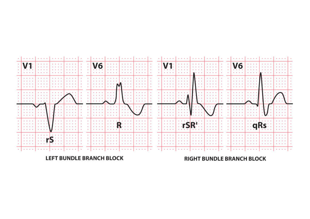 Right Anterior Bundle Branch Block