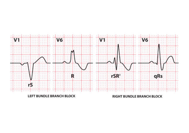 Bundle Branch Blocks (Part 1 – Left and Right Bundle Branch Blocks ...