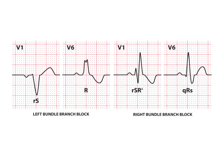 Bundle Branch Blocks (Part 1 – Left and Right Bundle Branch Blocks ...