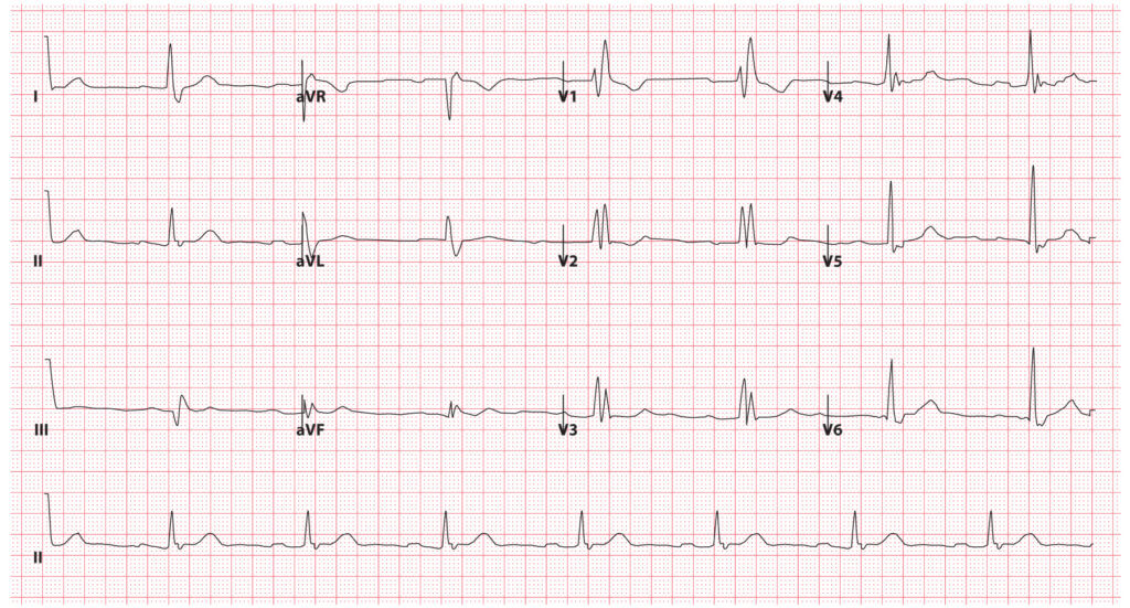 Bundle Branch Blocks (Part 1 – Left and Right Bundle Branch Blocks ...