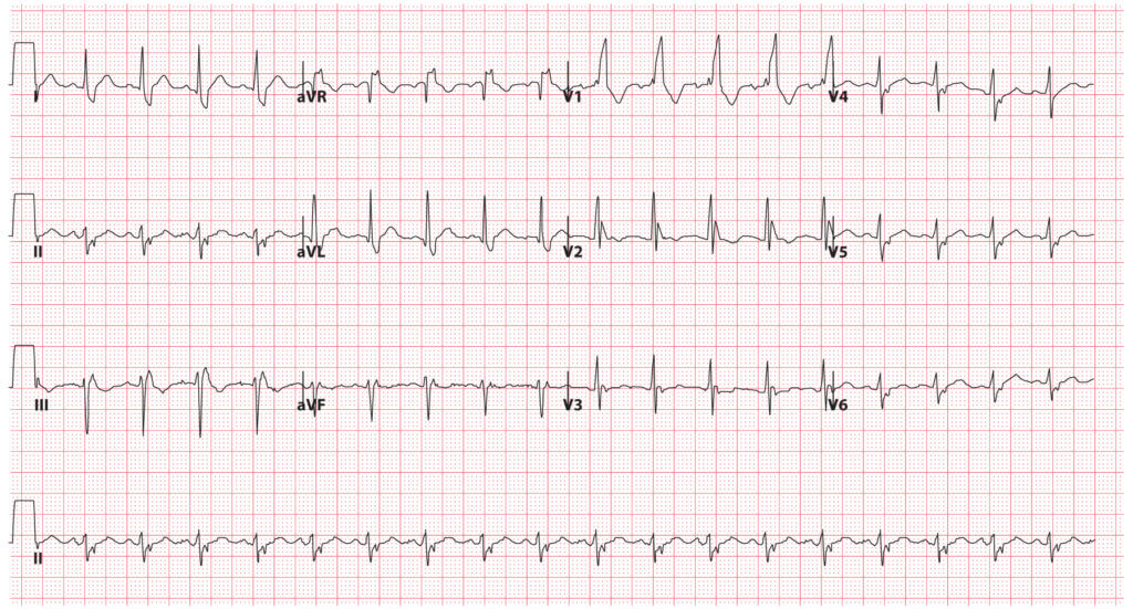 Bundle Branch Blocks (Part 2 – Fascicular Blocks) - Medical Exam Prep