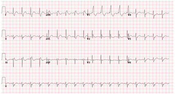 Bundle Branch Blocks (part 2 – Fascicular Blocks) - Medical Exam Prep