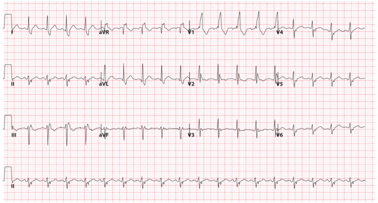 Bundle Branch Blocks (Part 2 – Fascicular Blocks) - Medical Exam Prep