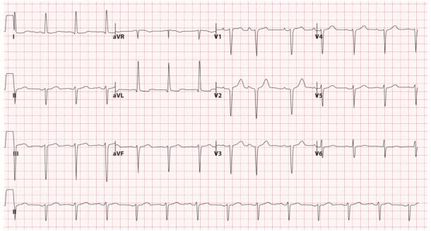 Bundle Branch Blocks (Part 2 – Fascicular Blocks) - Medical Exam Prep