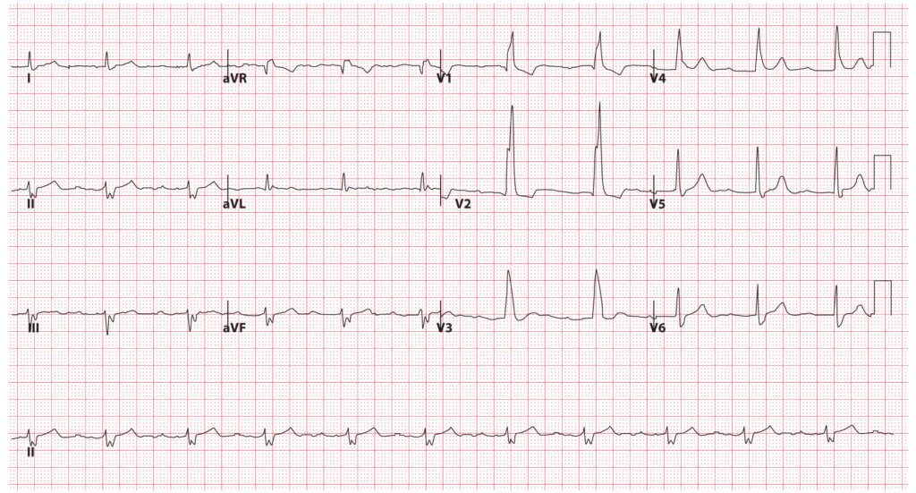 Bundle Branch Blocks (Part 2 – Fascicular Blocks) - Medical Exam Prep