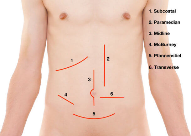 Langer’s Lines and Surgical Incisions - Medical Exam Prep