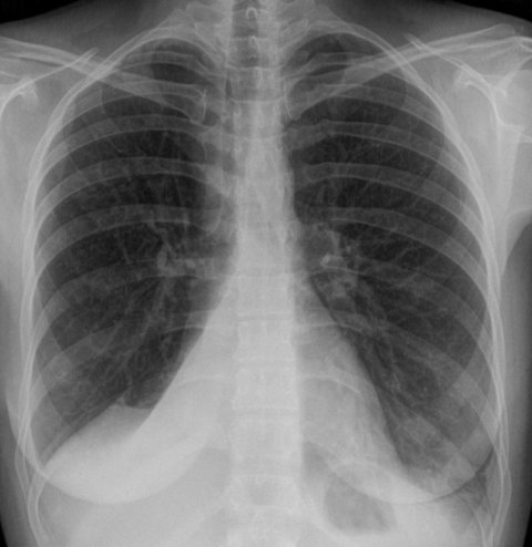 Diagnosing Pneumonia on Chest X-Ray - Medical Exam Prep