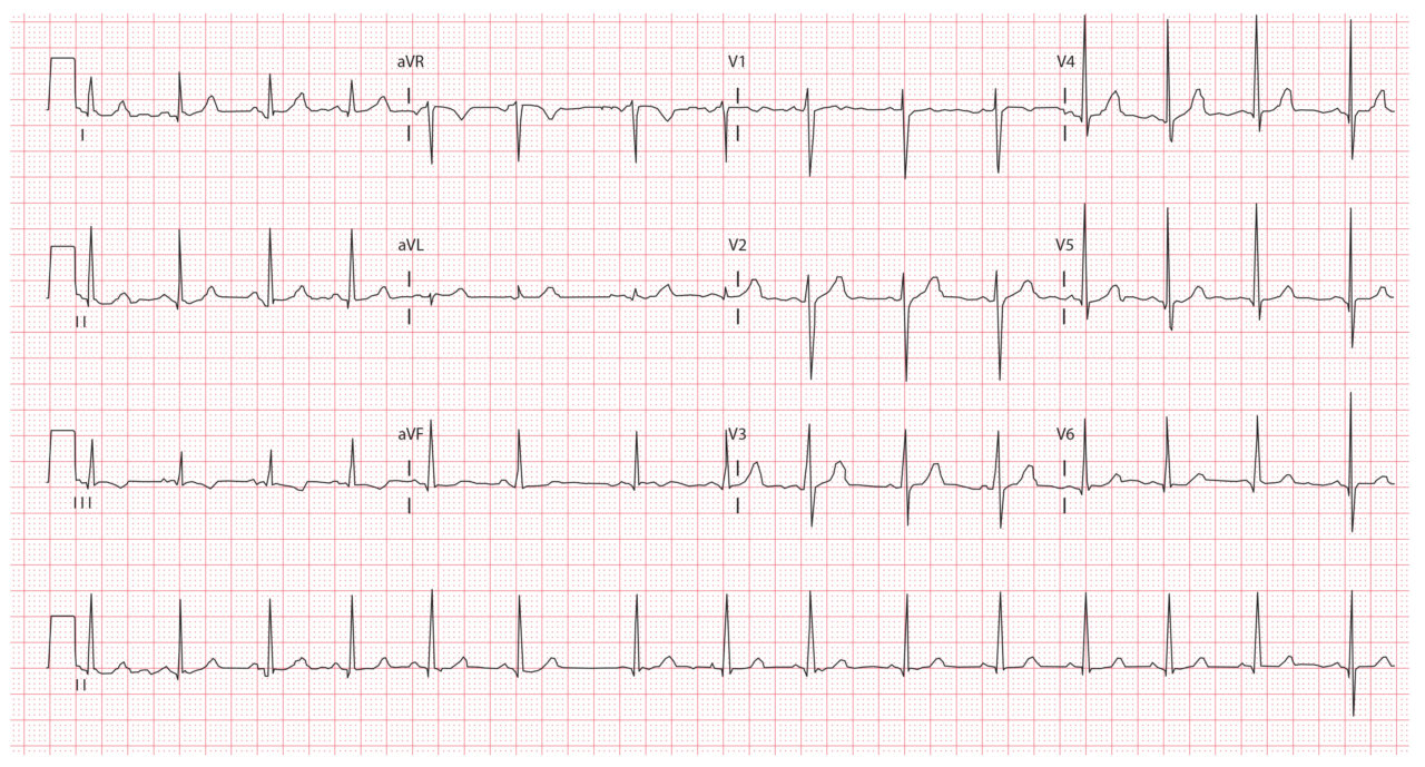 How To Read a Paediatric ECG - Medical Exam Prep