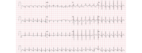 How To Read a Paediatric ECG - Medical Exam Prep