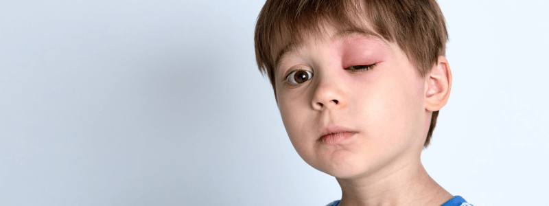 An 11-Year-Old Boy With a Painful Red Eye