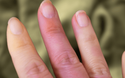 A 25-Year-Old Woman With Intermittent Finger Pain and Numbness