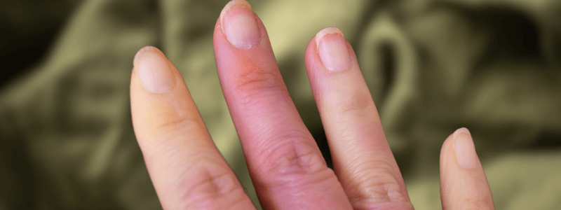 A 25-Year-Old Woman With Intermittent Finger Pain and Numbness